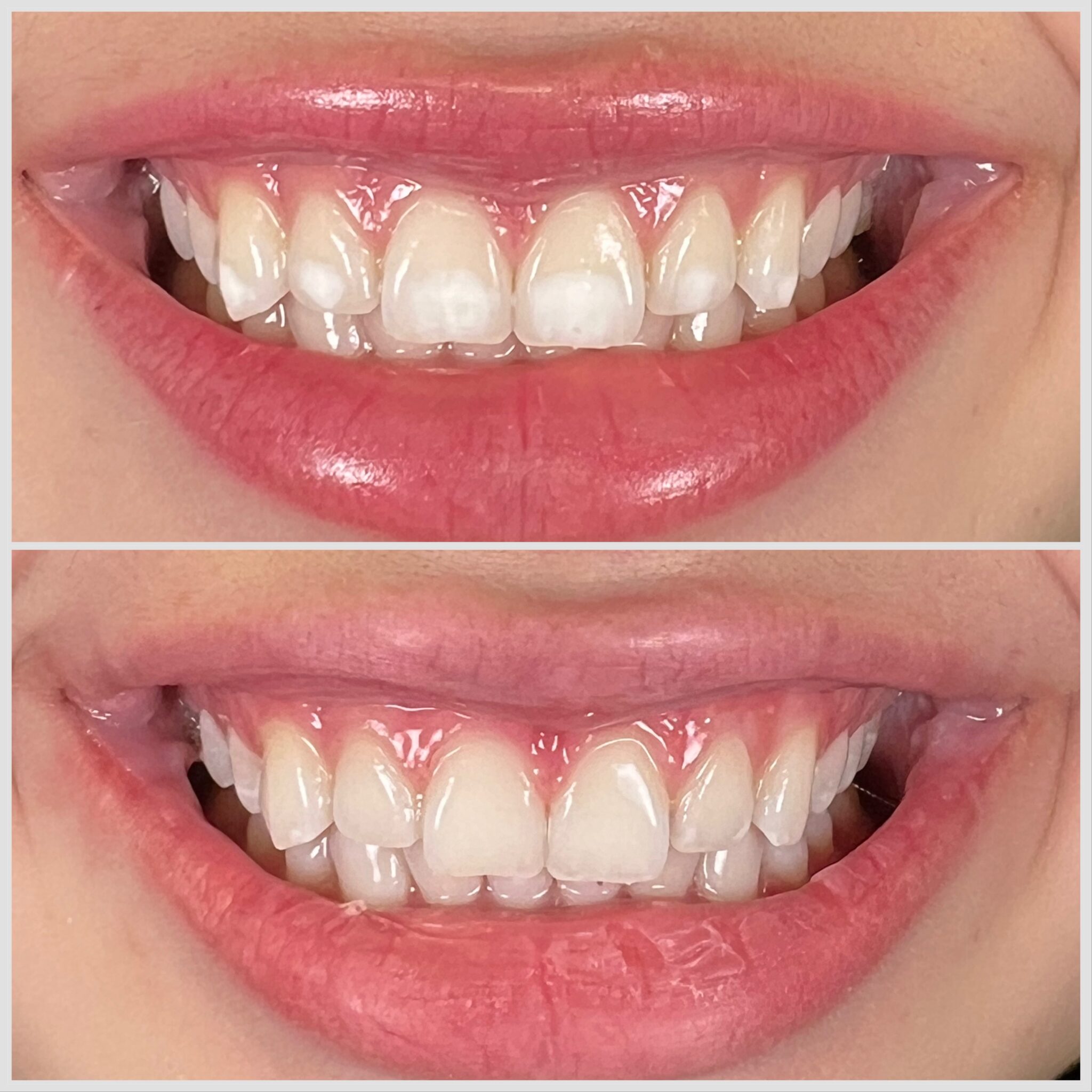 Close-up of white spot lesions on teeth treated with resin infiltration in Oakville
