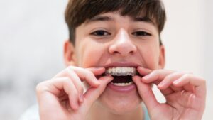 Invisalign for Teens
