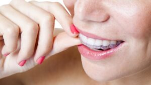 Invisalign for Straightening