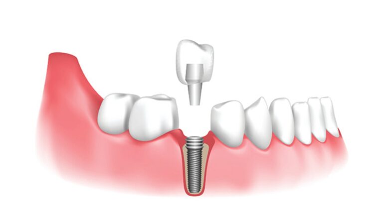 Dental Implants