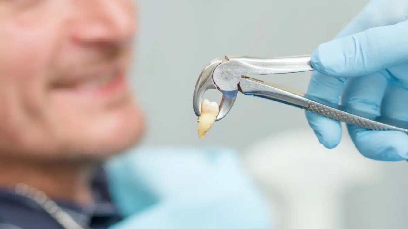 Extracted wisdom tooth held in forceps after a removal at Sol Dental Studio in Oakville