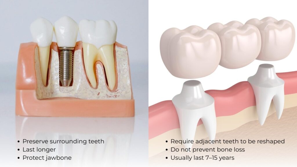 Comparing dental restoration options such as implants and bridges
